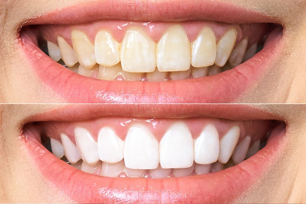 Das Bild zeigt einen Vergleich von gelb gefärbten Zähnen und weißen Zähnen durch Bleaching.