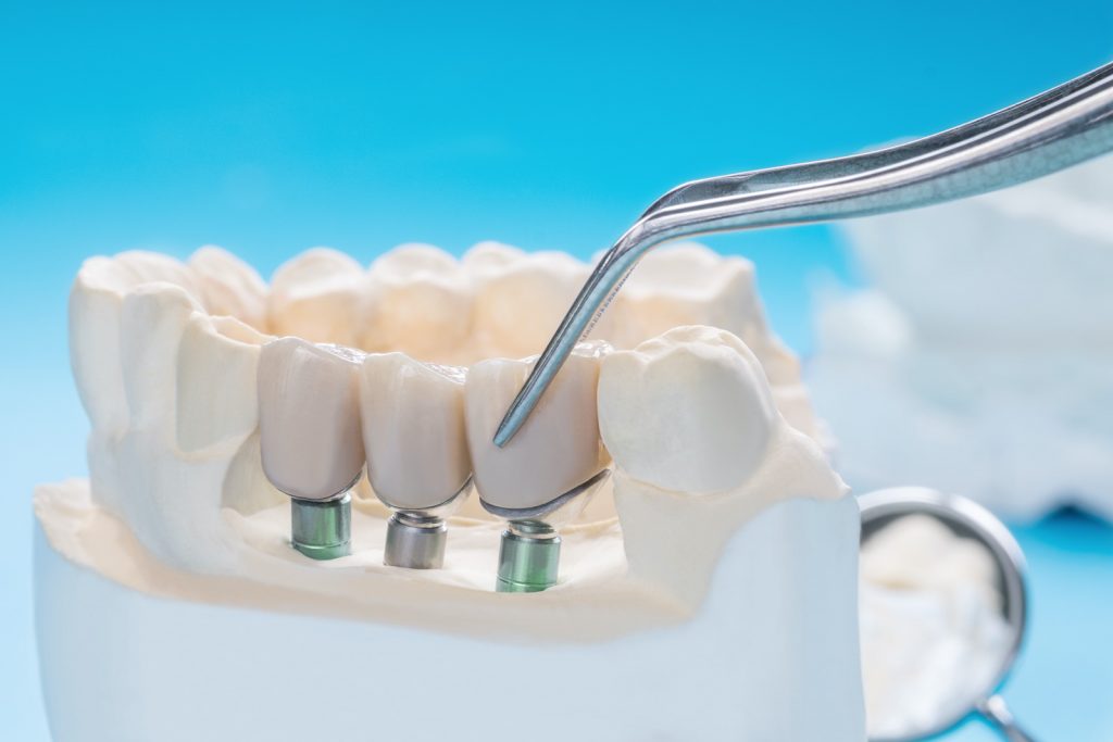 Das Bild zeigt ein Modell des Unterkiefers mit drei verschraubten Zahn-Implantaten