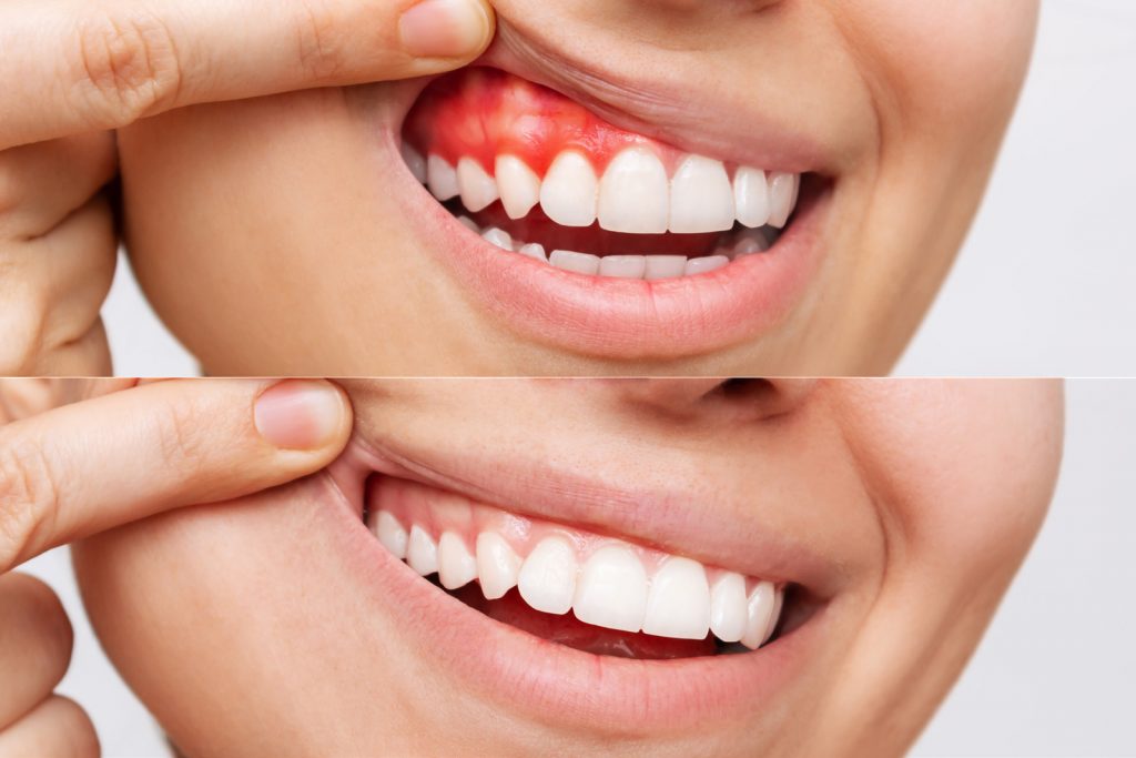 Parodontitisbehandlung. Das Bild zeigt einen Vergleich von entzündetem und gesunden Zahnfleisch