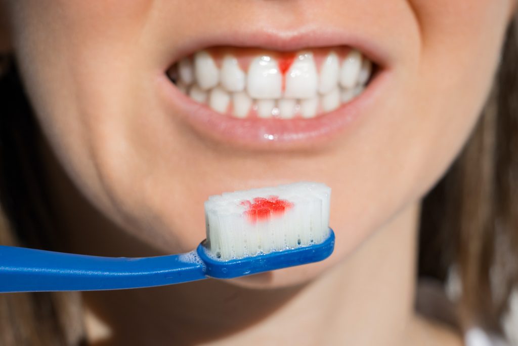 Parodontitisbehandlung. Das Bild zeigt eine blutige Zahnbürste von entzündetem Zahnfleich