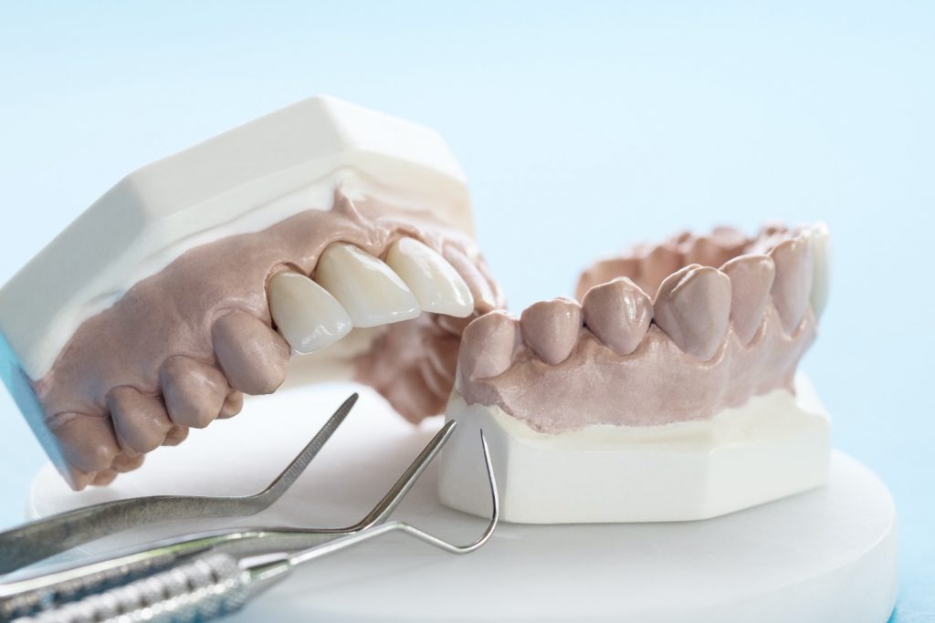 Das Bild zeigt ein Zahnmodell mit Zahnersatz in der oberen Zahnreihe